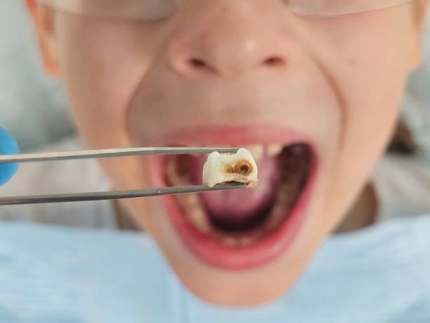 Best Emergency Root Canal Therapy in Gorman, TX